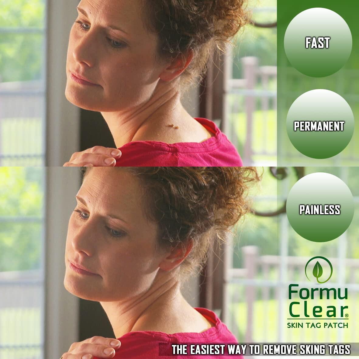 Formu Clear Skin Tag