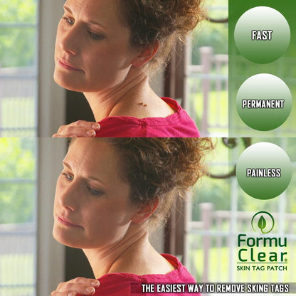 Formu Clear Skin Tag
