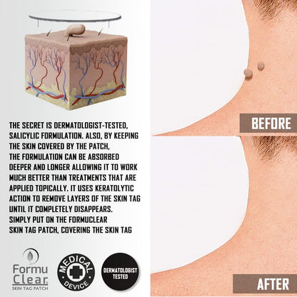 Formu Clear Skin Tag